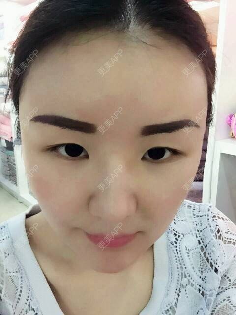 更美 - 李军 医生的自体脂肪全面部填充经验 | 美购日记 | 自体脂肪全面部填充 | 广州
