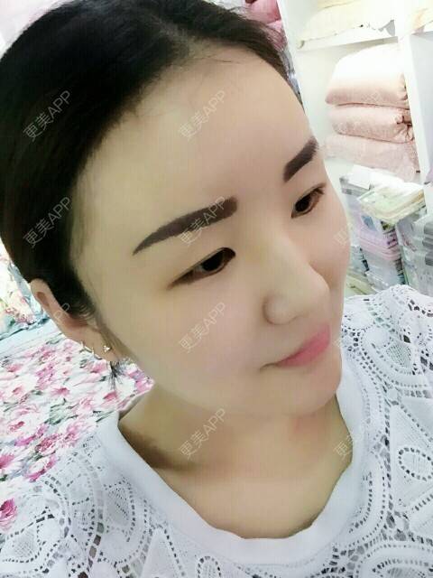 更美 - 李军 医生的自体脂肪全面部填充经验 | 美购日记 | 自体脂肪全面部填充 | 广州