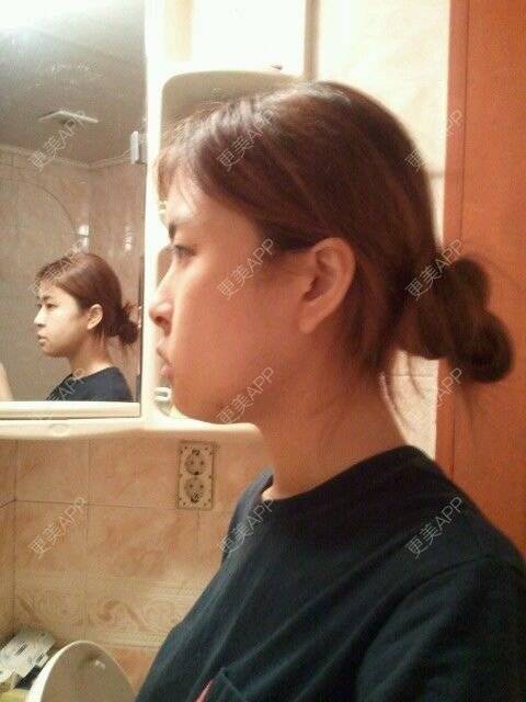 更美 - babi666的下颌角经验 | 下颌角 | 首尔