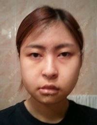 更美 - babi666的下颌角经验 | 下颌角 | 首尔