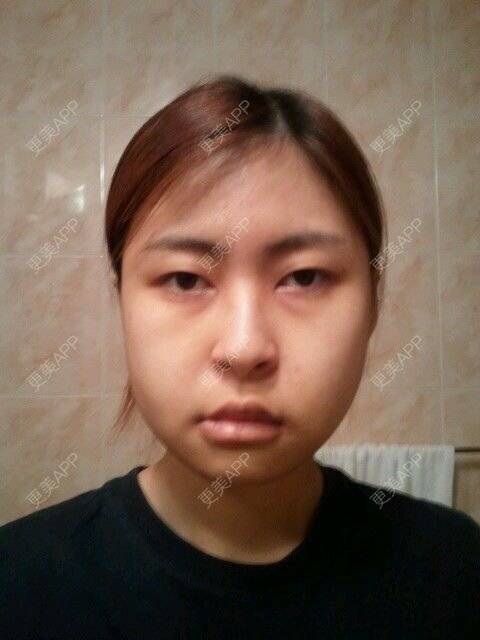 更美 - babi666的下颌角经验 | 下颌角 | 首尔