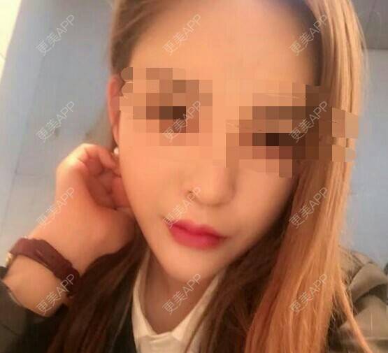 更美 - 不止心伤的玻尿酸唇部经验 | 玻尿酸唇部 | 注射美容 | 还好整了它 | 武汉