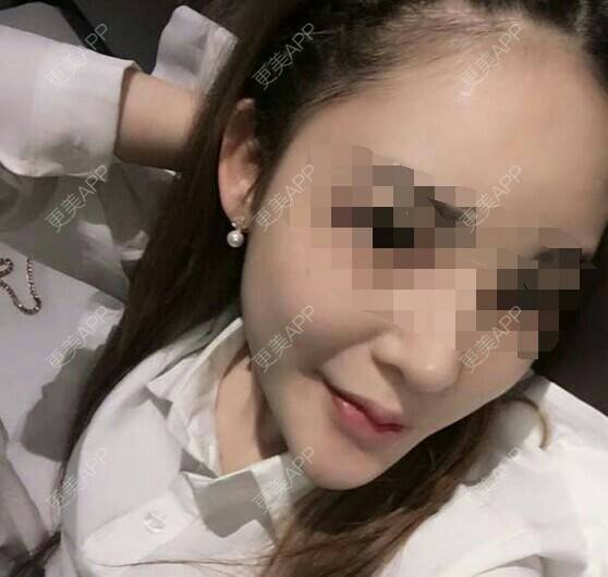 更美 - 不止心伤的玻尿酸唇部经验 | 玻尿酸唇部 | 注射美容 | 还好整了它 | 武汉