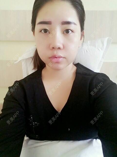 更美 - 你靖爸爸超酷的隆鼻经验 | 鼻尖延长 | 硅胶隆鼻 | 自体软骨垫鼻尖 | 隆鼻 | 美购日记 | 郑州