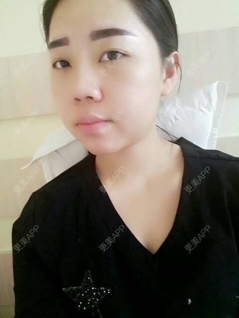 更美 - 你靖爸爸超酷的隆鼻经验 | 鼻尖延长 | 硅胶隆鼻 | 自体软骨垫鼻尖 | 隆鼻 | 美购日记 | 郑州