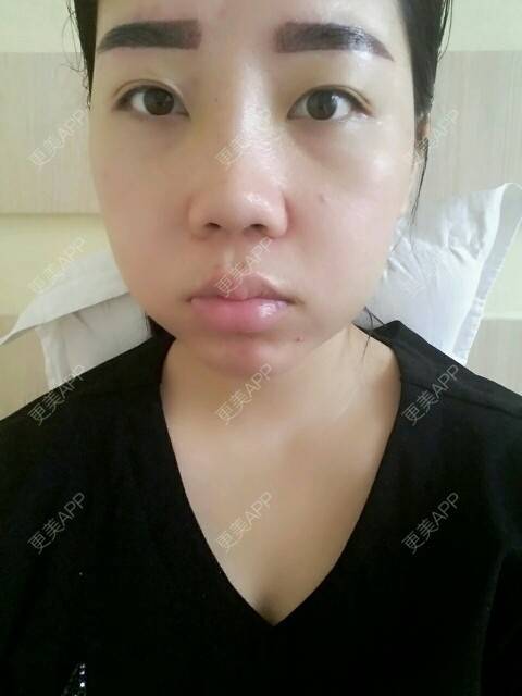 更美 - 你靖爸爸超酷的隆鼻经验 | 鼻尖延长 | 硅胶隆鼻 | 自体软骨垫鼻尖 | 隆鼻 | 美购日记 | 郑州