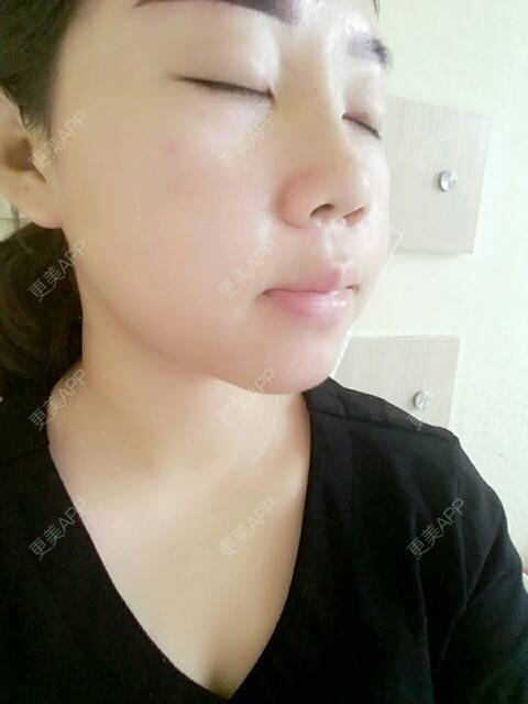 更美 - 你靖爸爸超酷的隆鼻经验 | 鼻尖延长 | 硅胶隆鼻 | 自体软骨垫鼻尖 | 隆鼻 | 美购日记 | 郑州