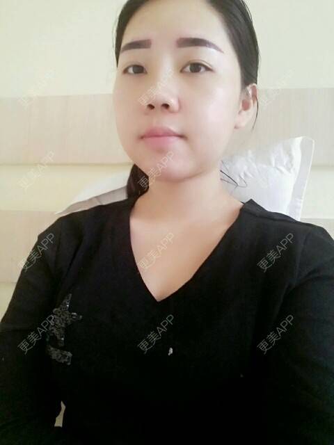 更美 - 你靖爸爸超酷的隆鼻经验 | 鼻尖延长 | 硅胶隆鼻 | 自体软骨垫鼻尖 | 隆鼻 | 美购日记 | 郑州