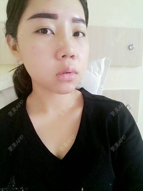 更美 - 你靖爸爸超酷的隆鼻经验 | 鼻尖延长 | 硅胶隆鼻 | 自体软骨垫鼻尖 | 隆鼻 | 美购日记 | 郑州