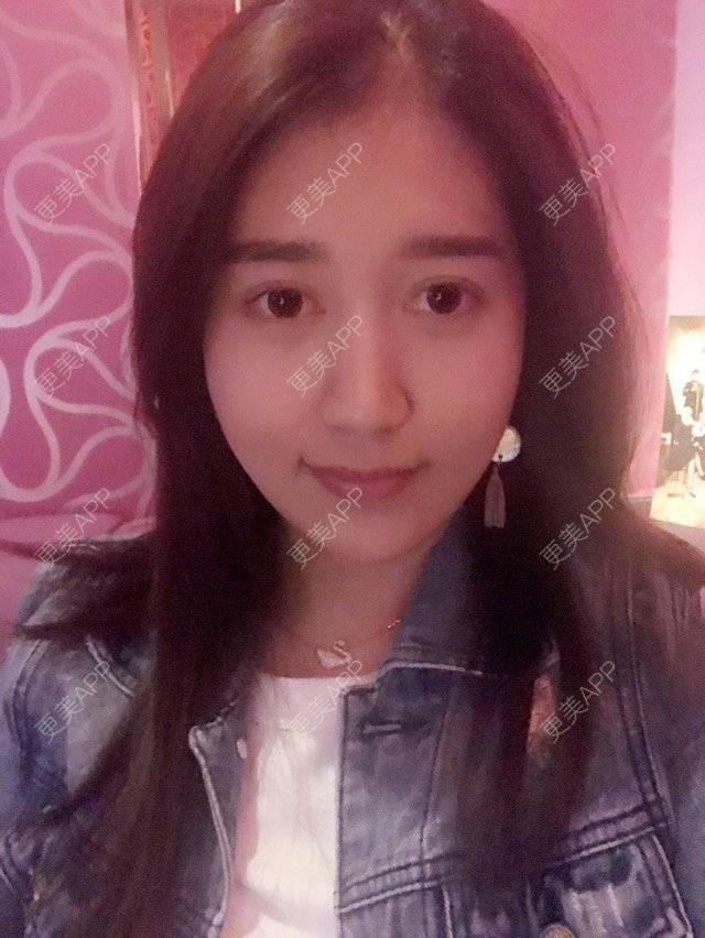 更美 - 大长腿欧尼的吸脂瘦脸经验 | 美购日记 | 吸脂瘦脸 | 双下巴吸脂 | 武汉