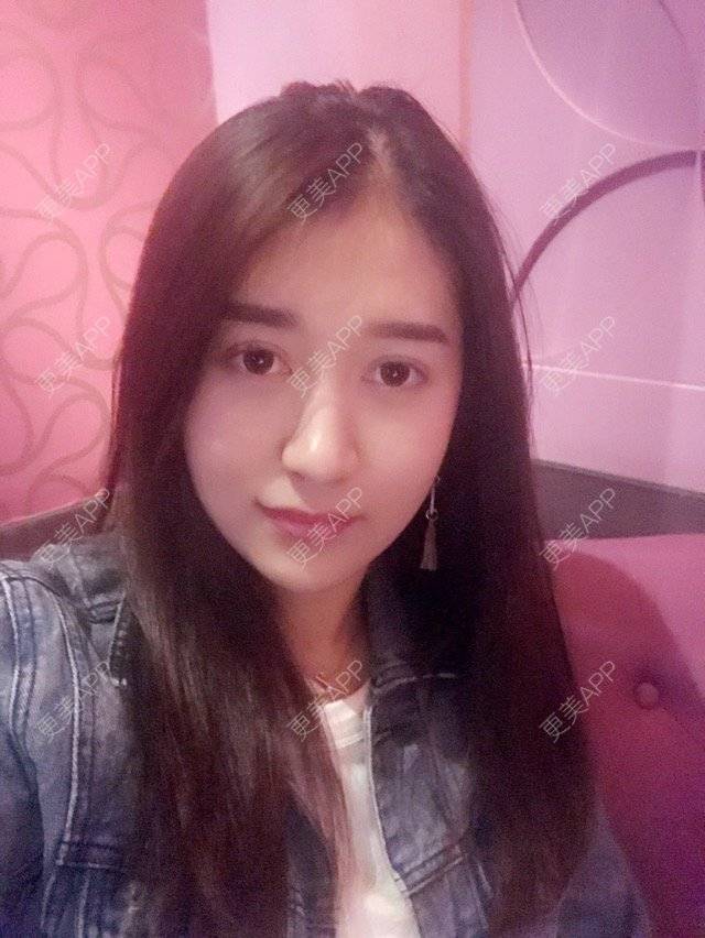 更美 - 大长腿欧尼的吸脂瘦脸经验 | 美购日记 | 吸脂瘦脸 | 双下巴吸脂 | 武汉