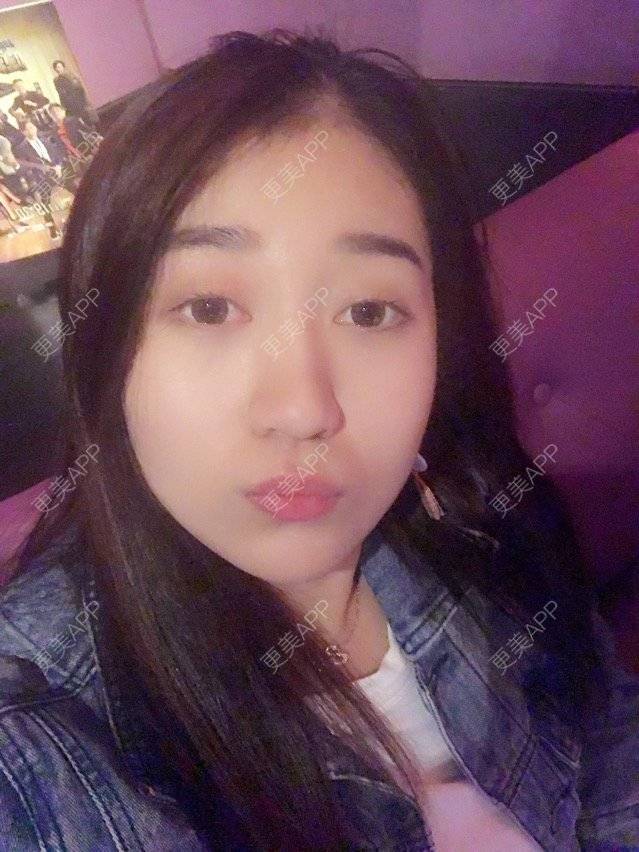 更美 - 大长腿欧尼的吸脂瘦脸经验 | 美购日记 | 吸脂瘦脸 | 双下巴吸脂 | 武汉