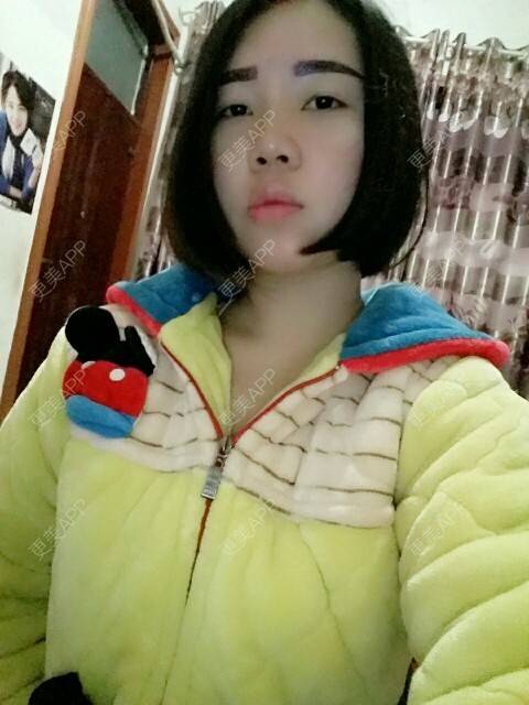 更美 - 你靖爸爸超酷的隆鼻经验 | 鼻尖延长 | 美购日记 | 自体软骨垫鼻尖 | 隆鼻 | 鼻部多项 | 郑州