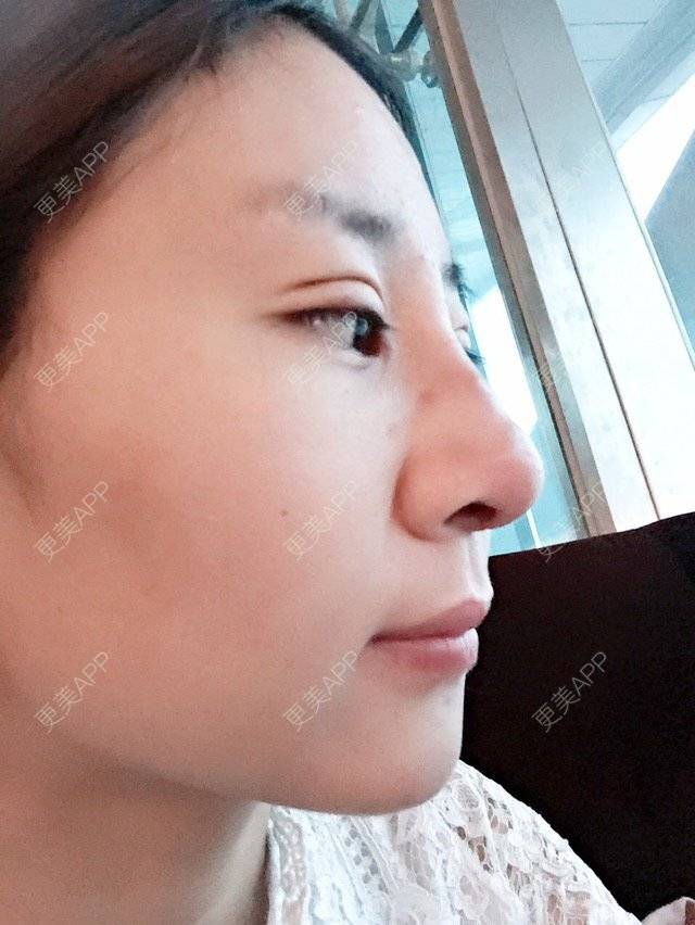 更美 - Cc Miss wu的双眼皮经验 | 美购日记 | 韩式三点加开眼角 | 双眼皮 | 重庆