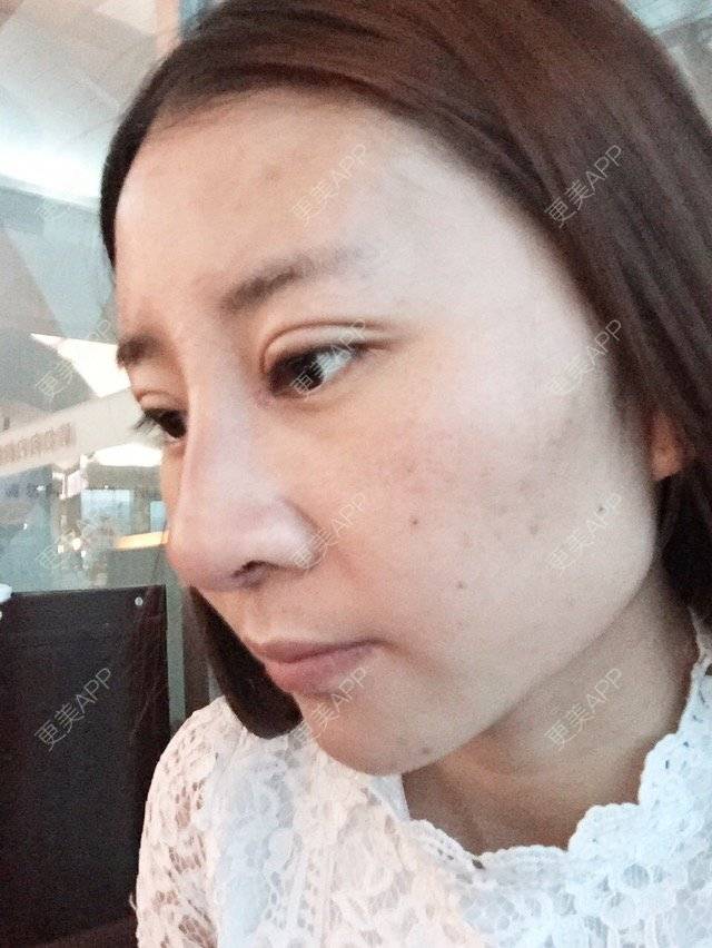 更美 - Cc Miss wu的双眼皮经验 | 美购日记 | 韩式三点加开眼角 | 双眼皮 | 重庆