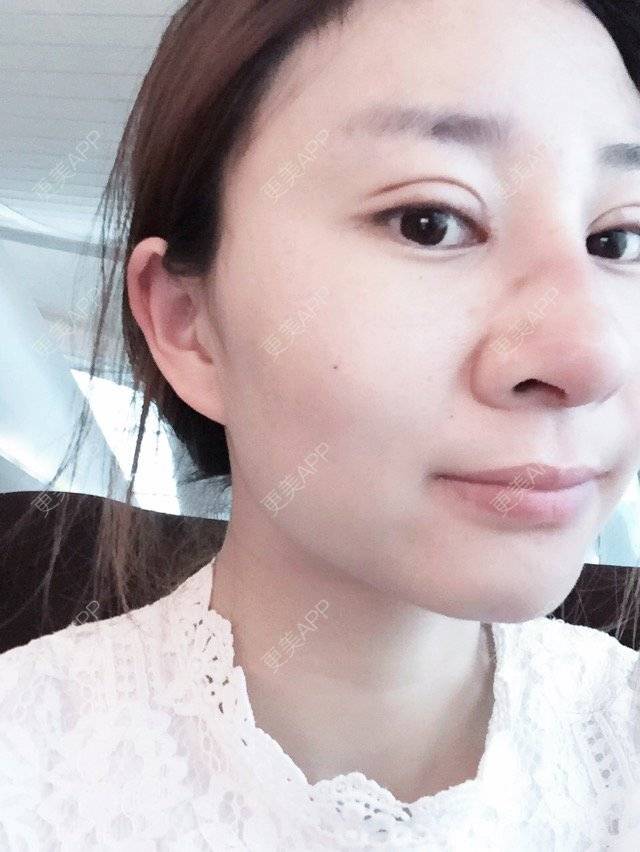 更美 - Cc Miss wu的双眼皮经验 | 美购日记 | 韩式三点加开眼角 | 双眼皮 | 重庆