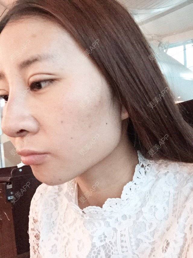 更美 - Cc Miss wu的双眼皮经验 | 美购日记 | 韩式三点加开眼角 | 双眼皮 | 重庆
