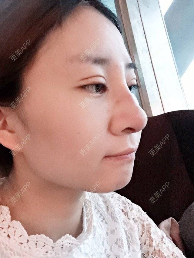 更美 - Cc Miss wu的双眼皮经验 | 美购日记 | 韩式三点加开眼角 | 双眼皮 | 重庆