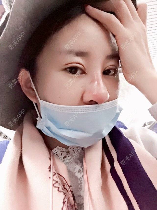 更美 - Cc Miss wu的双眼皮经验 | 美购日记 | 韩式三点加开眼角 | 双眼皮 | 重庆