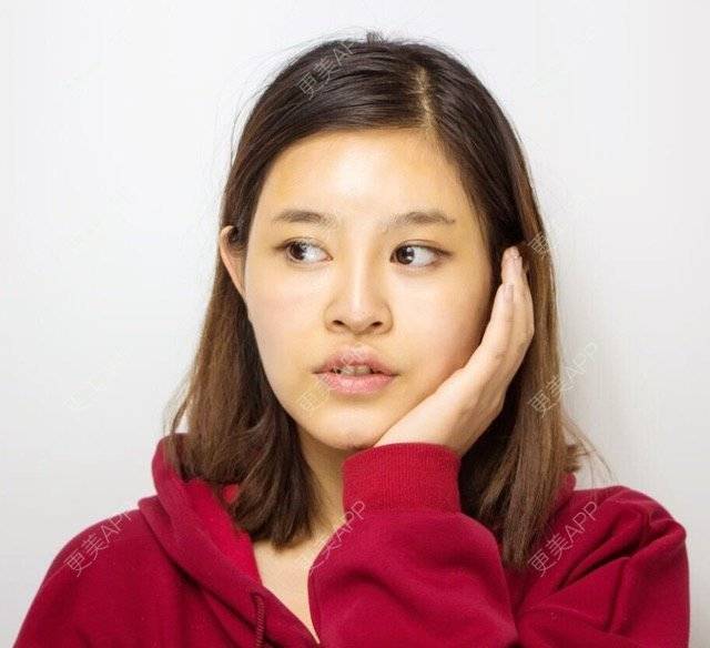 更美 - 微微①笑的吸脂经验 | 重庆 | 晒对比照 | 瘦腰腹 | 腰腹吸脂