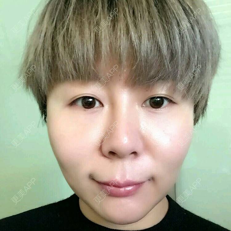 更美 - 祖国的小嫩草的超声提升经验 | 超声提升 | 抗衰老&除皱 | 提升抗衰 | 北京
