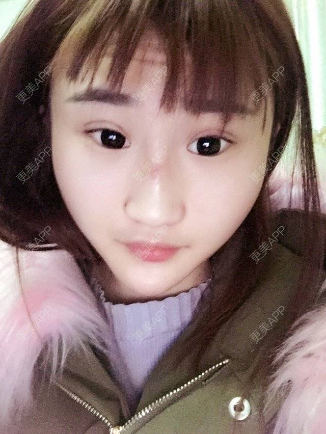 更美 - 莹阿妹的一天🎈的经验 | 韩国改脸型 | 颧骨磨骨