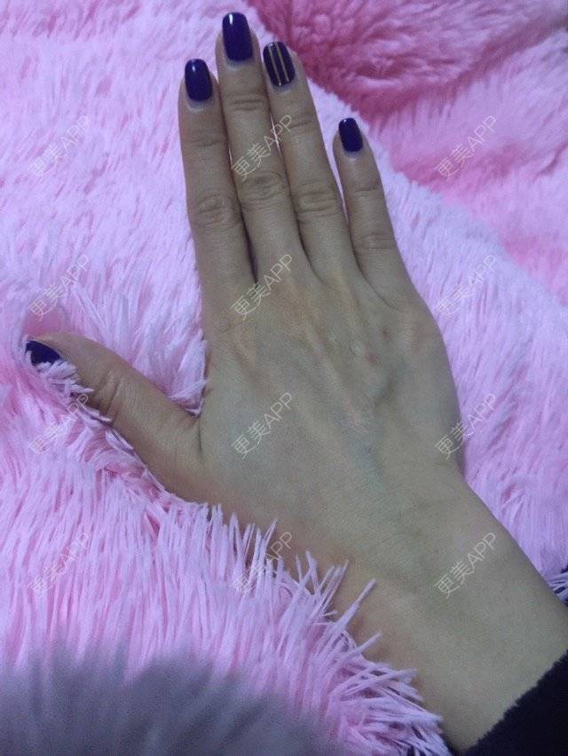 更美 - 更美用户a0tu0LRQ0f的经验 | 手背