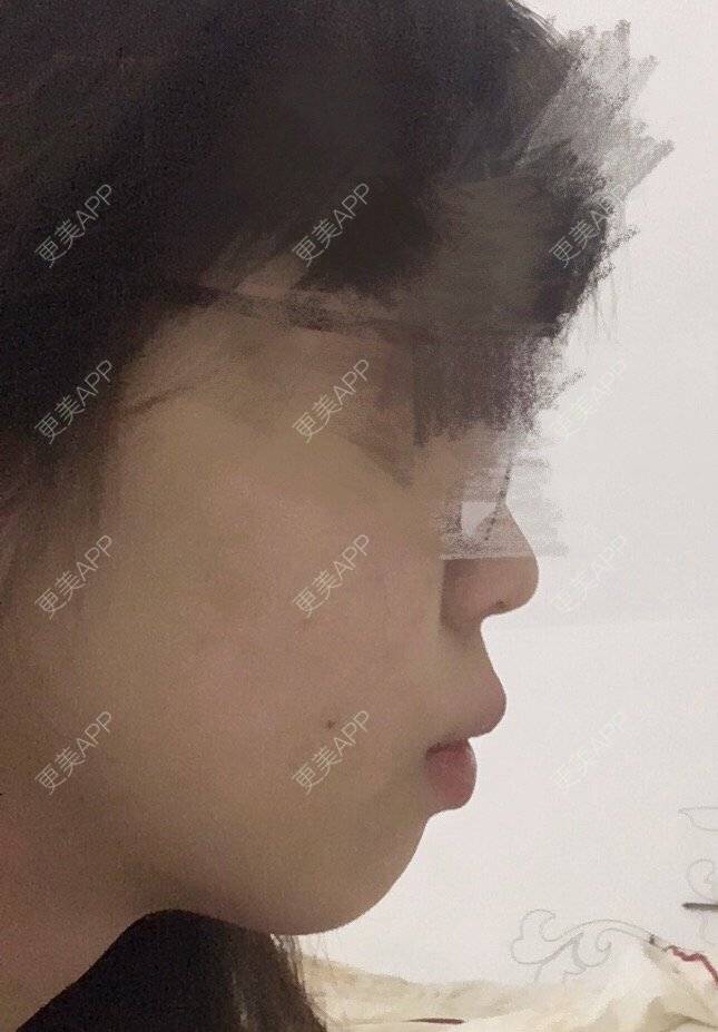 更美 - 蔓🐟Mandy的经验 | 丰下巴 | 硅胶垫下巴 | 膨体垫下巴 | 广州