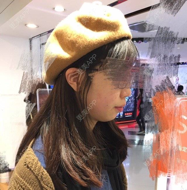 更美 - 蔓🐟Mandy的经验 | 丰下巴 | 硅胶垫下巴 | 膨体垫下巴 | 广州