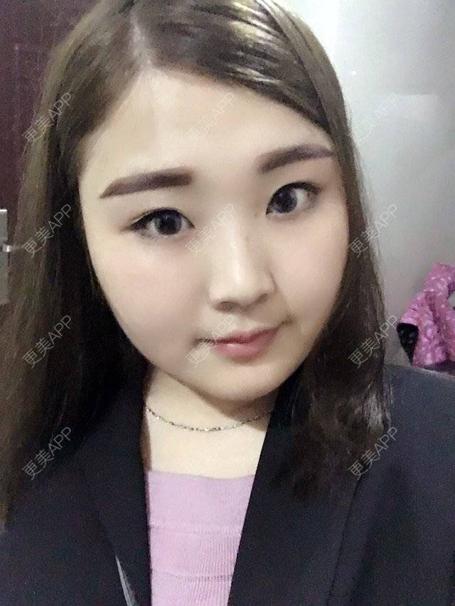 更美 - 阿茉茉茉茉的经验 | 面部轮廓 | 吸脂瘦脸 | 合肥