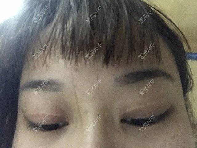 更美 - =͟͟͞͞( •̀д•́)💦的经验 | 疤痕 | 求助 | 全切开双眼皮