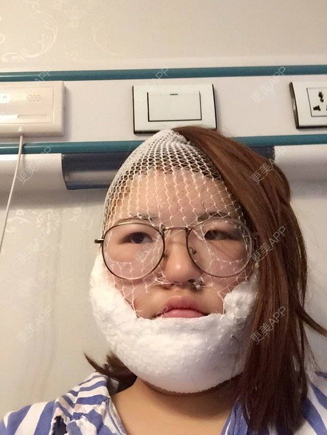 更美 - 呛口丸🍘的经验 | 还好整了它 | 成都 | 全脸吸脂 | 吸脂瘦大腿
