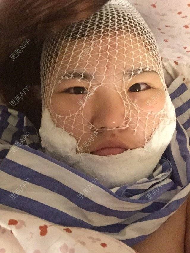 更美 - 呛口丸🍘的经验 | 还好整了它 | 成都 | 全脸吸脂 | 吸脂瘦大腿