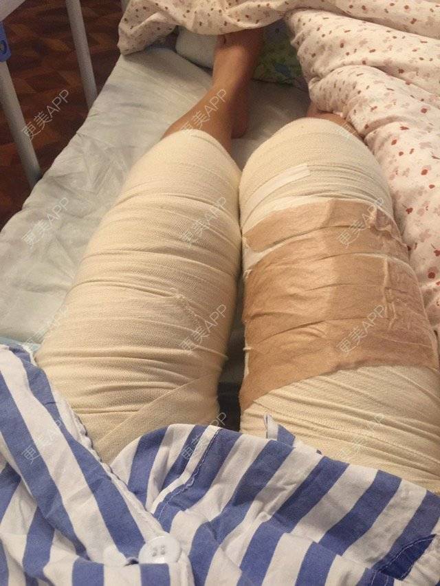 更美 - 呛口丸🍘的经验 | 还好整了它 | 成都 | 全脸吸脂 | 吸脂瘦大腿