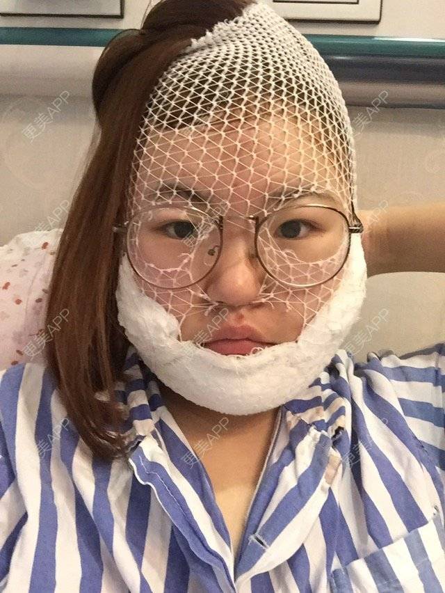 更美 - 呛口丸🍘的经验 | 还好整了它 | 成都 | 全脸吸脂 | 吸脂瘦大腿