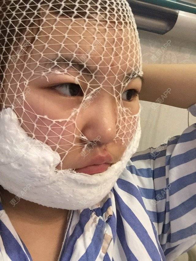 更美 - 呛口丸🍘的经验 | 还好整了它 | 成都 | 全脸吸脂 | 吸脂瘦大腿