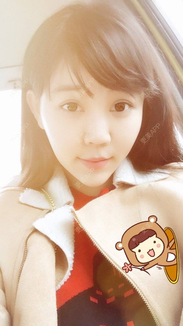 更美 - 🐯🐯🐯婷的全切双眼皮经验 | 廊坊 | 双眼皮和开内眼角 | 全切双眼皮 | 外开眼角
