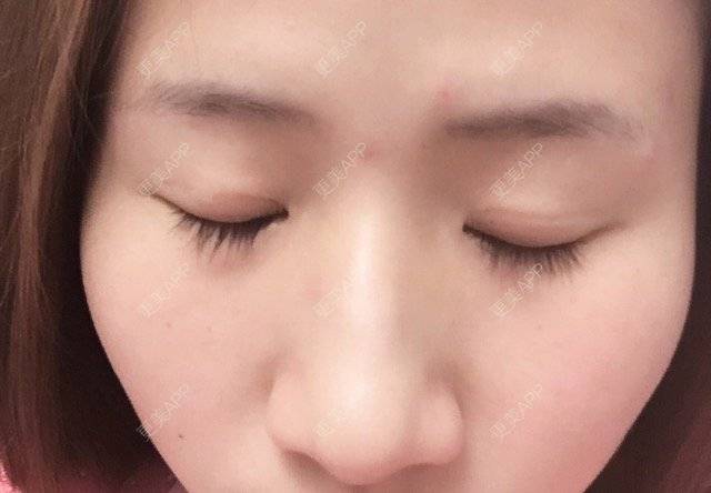 更美 - lllivia的经验 | 你看我整哪 | 无痕开眼角 | 哈尔滨