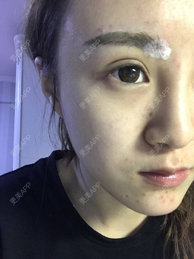 更美 - 萌面小喵喵的经验 | 双眼皮修复