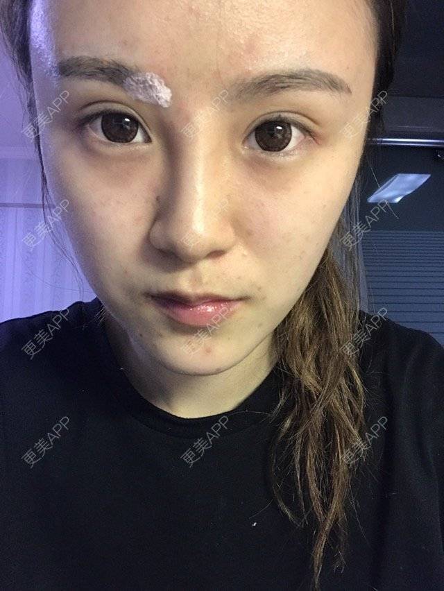 更美 - 萌面小喵喵的经验 | 双眼皮修复