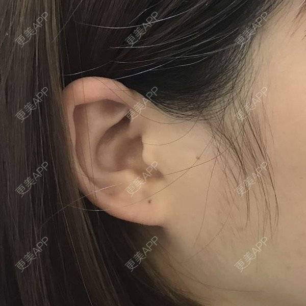 更美 - 五大啦的丰耳垂经验 | 耳垂 | 还好整了它 | 丰耳垂 | 成都
