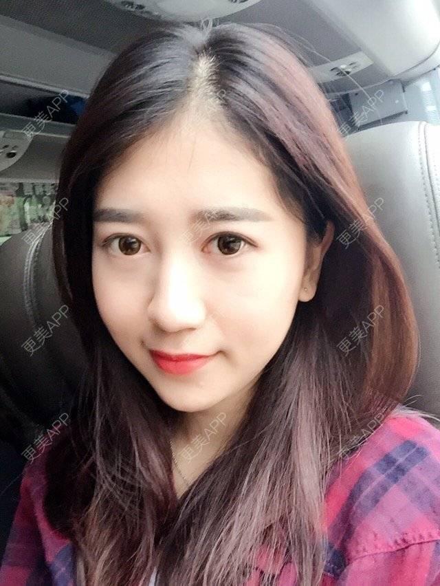 更美 - 大长腿欧尼的吸脂瘦脸经验 | 美购日记 | 吸脂瘦脸 | 双下巴吸脂 | 武汉