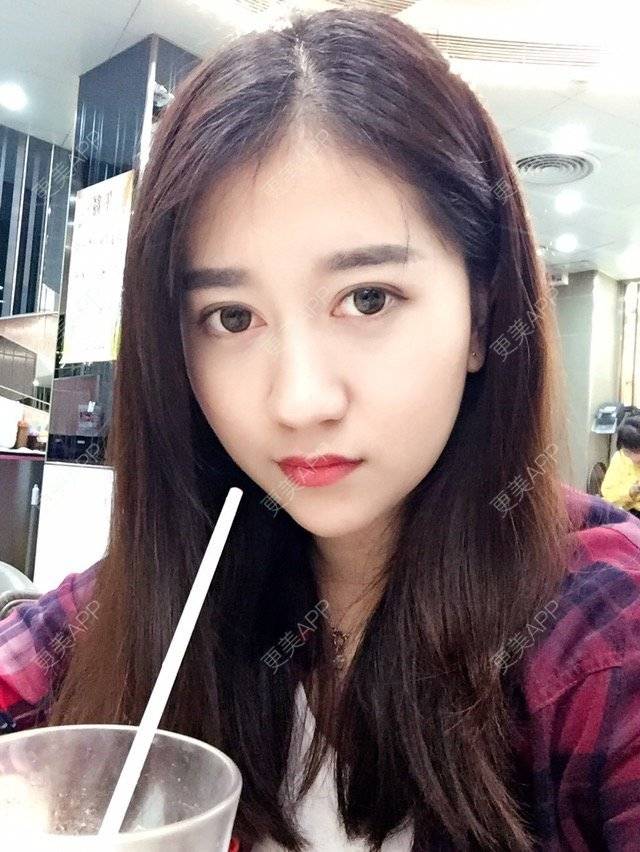 更美 - 大长腿欧尼的吸脂瘦脸经验 | 美购日记 | 吸脂瘦脸 | 双下巴吸脂 | 武汉