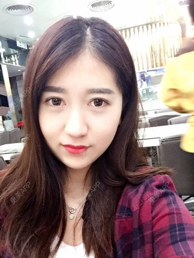 更美 - 大长腿欧尼的吸脂瘦脸经验 | 美购日记 | 吸脂瘦脸 | 双下巴吸脂 | 武汉