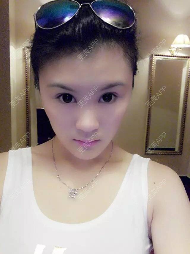 更美 - 梦想飞扬的糖的经验 | 自体软骨垫鼻尖 | 南昌