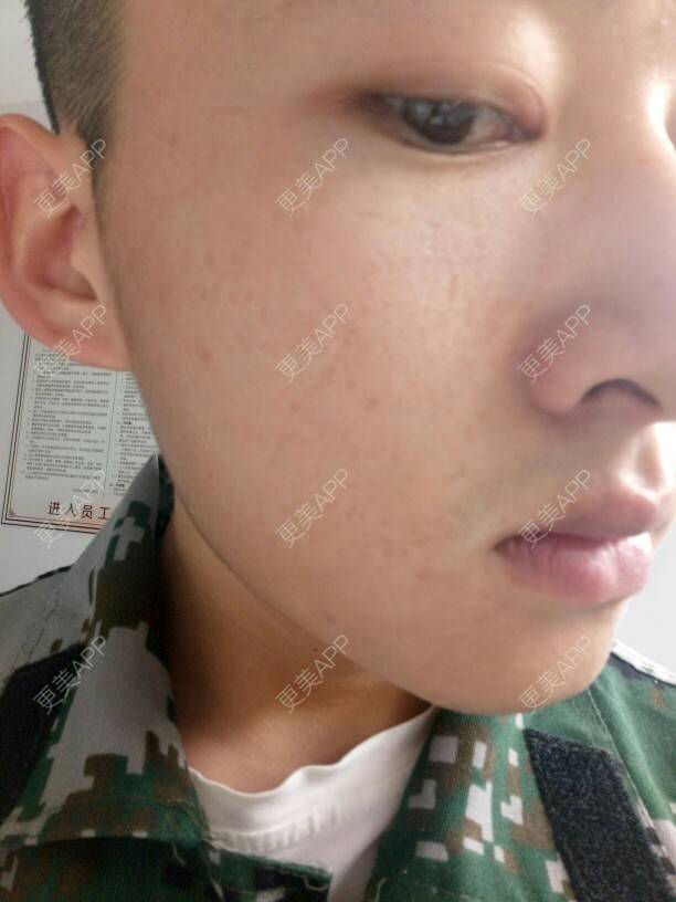 更美 - 更美用户4N3N1qcuiY的经验 | 面部轮廓 | 疤痕 | 深圳