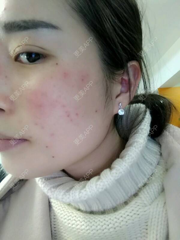 更美 - 哟哟iu的激光淡斑经验 | 激光淡斑 | 彩光祛斑