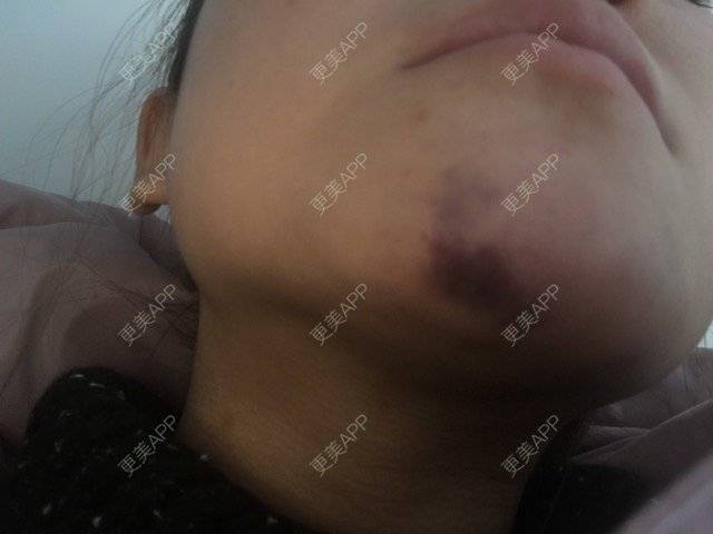 更美 - 蕾洛的经验 | 溶解酶 | 玻尿酸溶解酶 | 玻尿酸注射下巴 | 松原