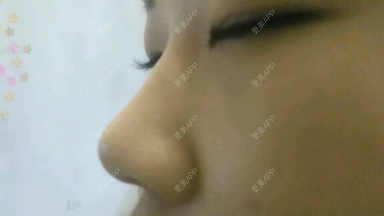 更美 - A.择优从善.的经验 | 玻尿酸鼻部 | 伊春