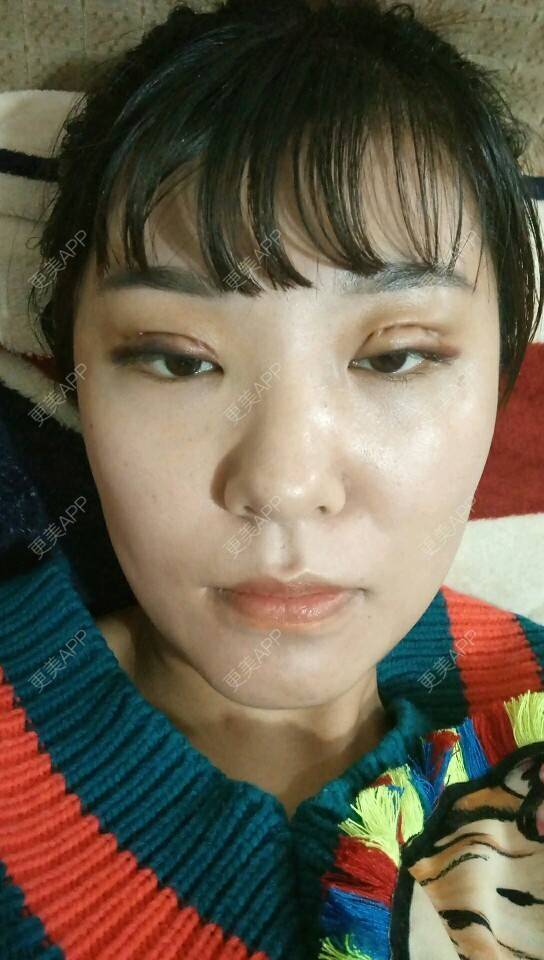 更美 - -生活太简单人心太复杂-的经验 | 眼部整形 | 埋线双眼皮术后
